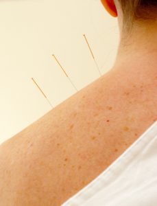 Fire Element Acupuncture